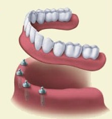 Dentures | W. Kelly Harris DDS | Asheboro, NC