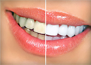 Whitening | Before and After | Asheboro, NC