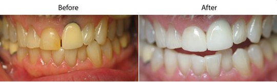 Dental Crowns | W. Kelly Harris DDS | Asheboro, NC