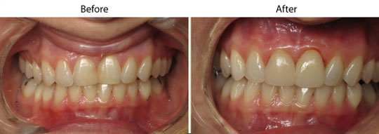 Veneers | Before and After | W. Kelly Harris DDS | Asheboro, NC