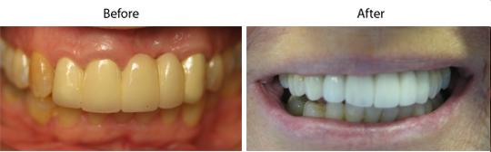 Dental Crowns | W. Kelly Harris DDS | Asheboro, NC 