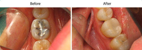 CEREC Same Day Restorations | W. Kelly Harris DDS | Asheboro, NC