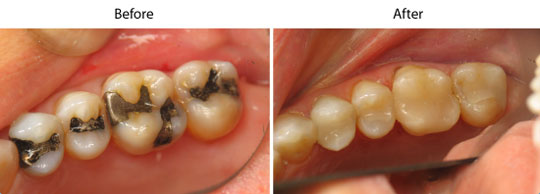Tooth Colored Fillings | W. Kelly Harris DDS | Asheboro, NC Tooth Colored Fillings | W. Kelly Harris DDS | Asheboro, NC