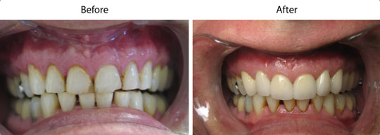 Crowns and Bridges | Before and After | W. Kelly Harris DDS | Asheboro, NC