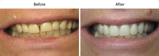 Dentures | Before and After | W. Kelly Harris DDS | Asheboro, NC