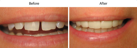 Before and After Cosmetic Treatment | W. Kelly Harris DDS | Asheboro