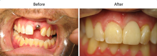 Dental Implants | W. Kelly Harris DDS | Asheboro, NC