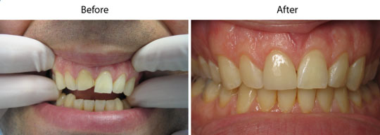 Veneers | Before and After | W. Kelly Harris DDS | Asheboro, NC