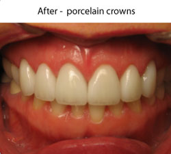 Crowns and Bridges | After | W. Kelly Harris DDS | Asheboro, NC