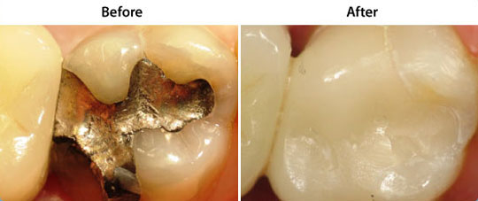 CEREC Same Day Restorations | W. Kelly Harris DDS | Asheboro, NC
