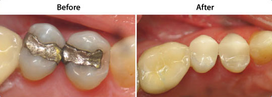 CEREC Same Day Restorations | W. Kelly Harris DDS | Asheboro, NC