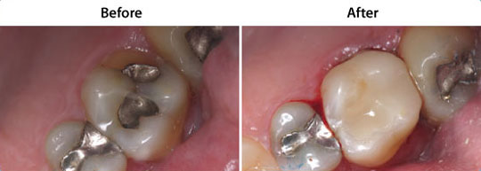 CEREC Same Day Restorations | W. Kelly Harris DDS | Asheboro, NC
