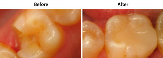 CEREC Same Day Restorations | W. Kelly Harris DDS | Asheboro, NC