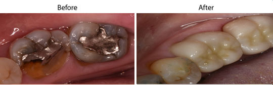 Dental Crowns | W. Kelly Harris DDS | Asheboro, NC