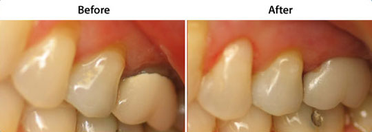 Crowns and Bridges | Before and After | W. Kelly Harris DDS | Asheboro, NC