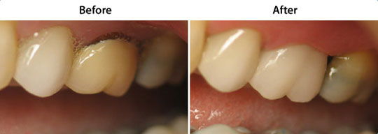 CEREC Same Day Restorations | W. Kelly Harris DDS | Asheboro, NC