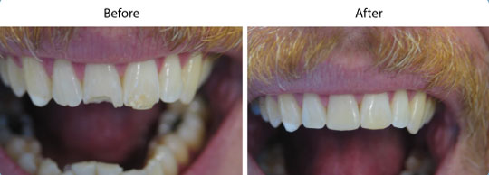 Tooth Colored Fillings | W. Kelly Harris DDS | Asheboro, NC