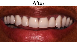 Dentures | Before and After | W. Kelly Harris DDS | Asheboro, NC