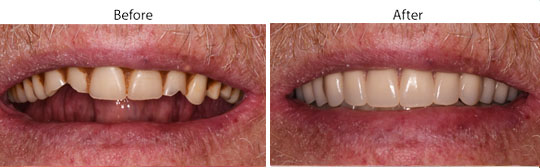 Dentures | Before and After | W. Kelly Harris DDS | Asheboro, NC