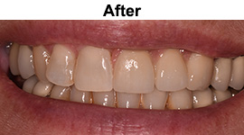 Dental Implants | W. Kelly Harris DDS | Asheboro, NC