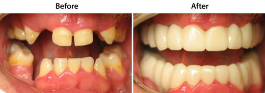 Snap On Smile | W. Kelly Harris, DDS | Asheboro, NC