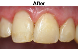 Tooth Colored Fillings | Asheboro Dentist