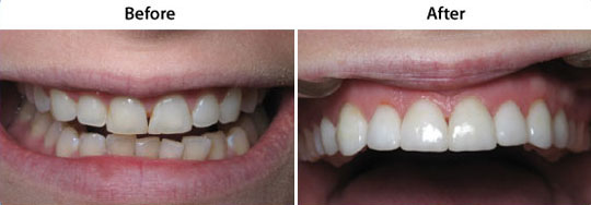 Veneers | Before and After | W. Kelly Harris DDS | Asheboro, NC