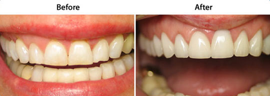 Veneers | Before and After | W. Kelly Harris DDS | Asheboro, NC