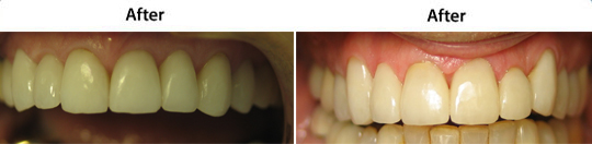 Veneers | W. Kelly Harris DDS | Asheboro, NC