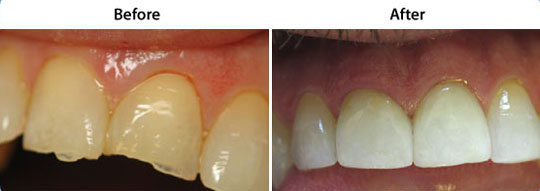 Veneers | Before and After | W. Kelly Harris DDS | Asheboro, NC