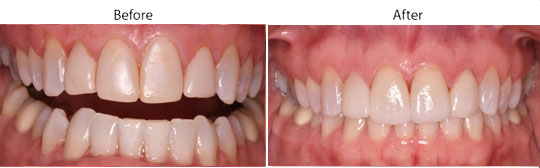 Veneers | W. Kelly Harris DDS | Asheboro, NC