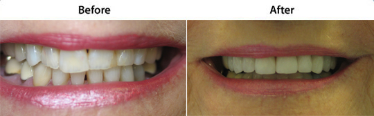 Veneers | W. Kelly Harris DDS | Asheboro, NC