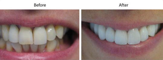 Before and After Cosmetic Treatment | W. Kelly Harris DDS | Asheboro