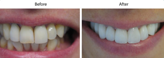 Veneers | Before and After | W. Kelly Harris DDS | Asheboro, NC