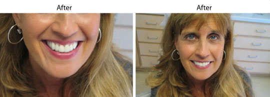 Before and After Cosmetic Treatment | W. Kelly Harris DDS | Asheboro