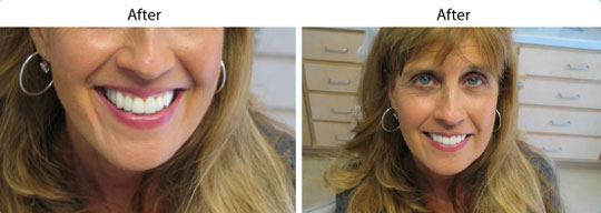 Veneers | Before and After | W. Kelly Harris DDS | Asheboro, NC